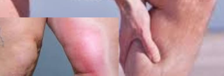 💧🩺 Why doesn’t dehydration during voluntary fasting lead to dangerous blood clots? Discover how th
