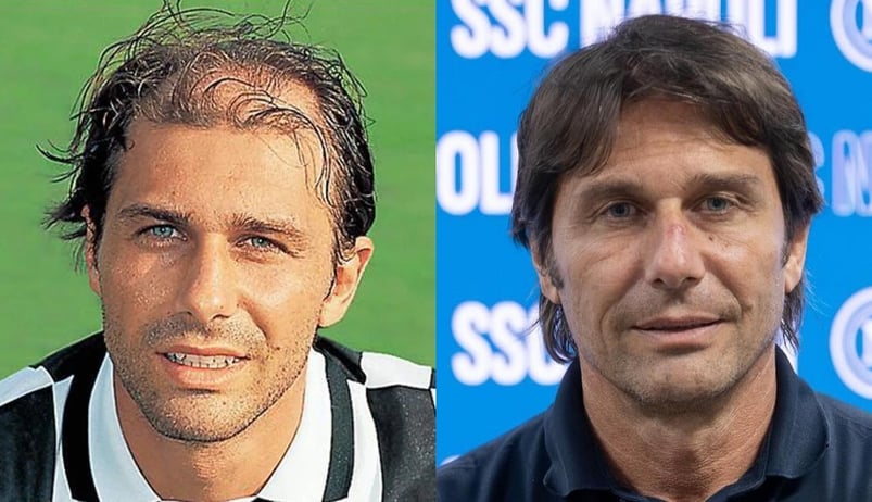 Antonio Conte hair transplant