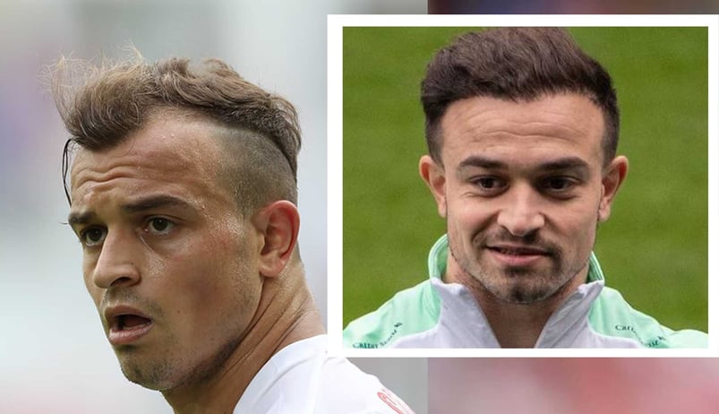 Xherdan Shaqiri hair transplant