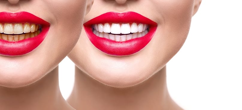 Best Teeth Whitening Service in Wadgaon sheri