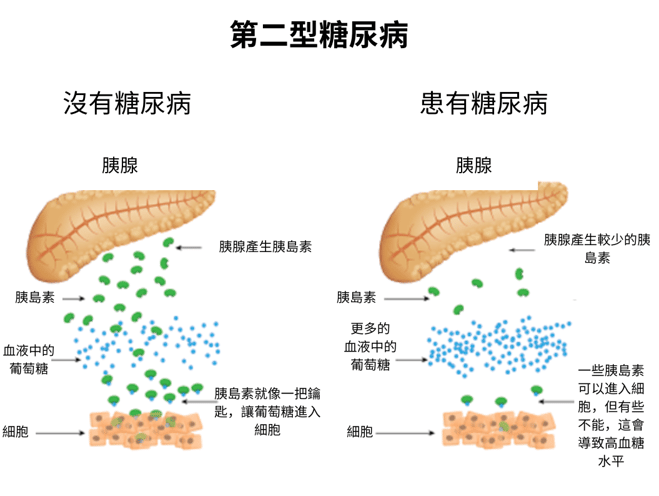 第二型糖尿病