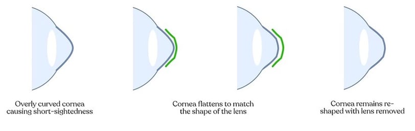 orthokeratology-cornea-reshaping-overnight