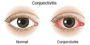 conjunctivitis, pink eyes