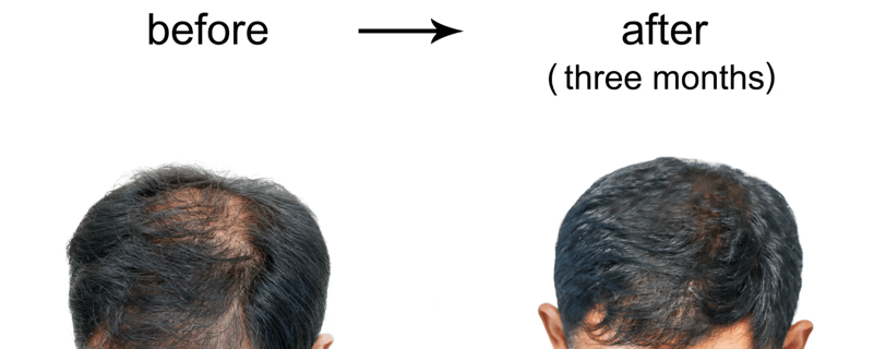 How Does Caffeine Shampoo Combat Hair Loss?