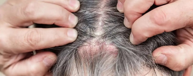 Top Sulfate-Free Shampoos for Itchy Scalps