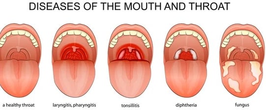 Understanding Diphtheria