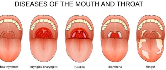 diphtheria