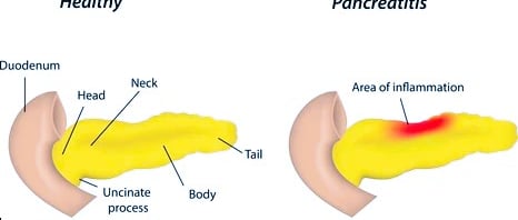 pancreatitis