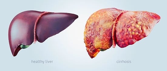 lever cirrhosis