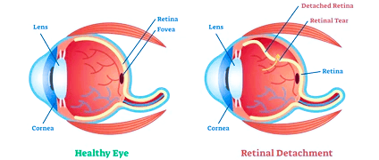 Retinal Disorders