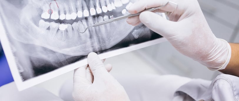 Planificacion de un implante dental