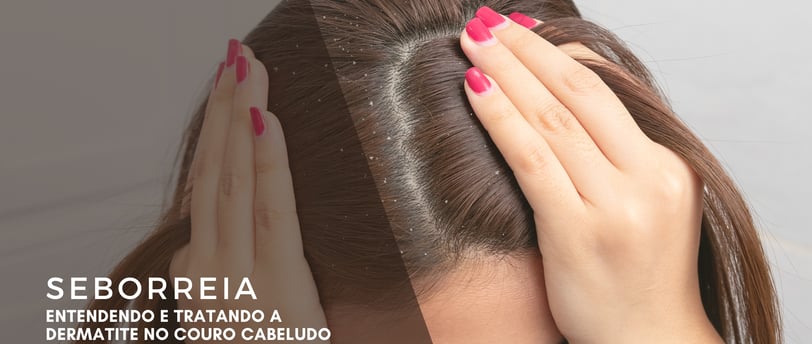seborreia, dermatite no couro cabeludo