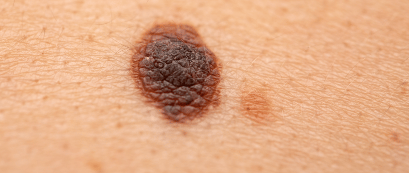 skin spot