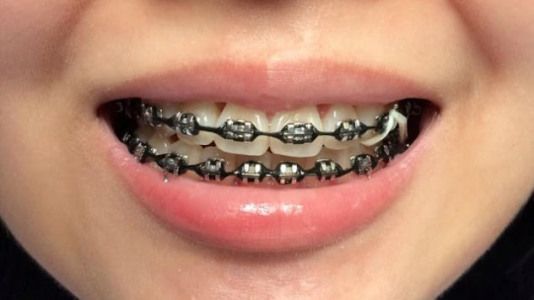 Close-up of a person smiling with black bands on braces, showing the popular braces color black opti
