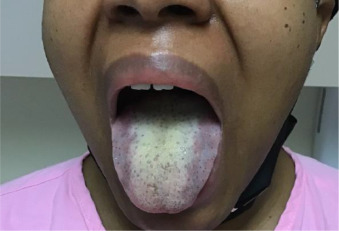 a image showing tongue with white patches