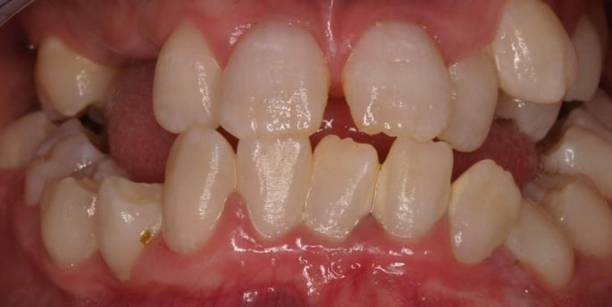 a image showing teeth with dentin dysplasia