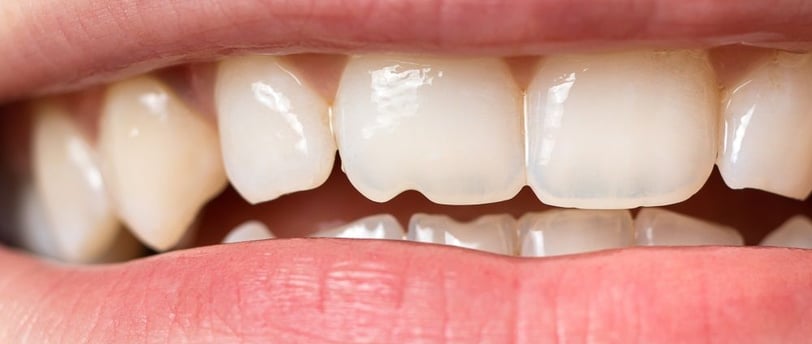 A image showing upper maxillary teeth in mouth