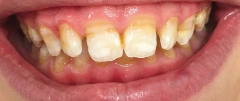 a image showing teeth with white spots in mouth