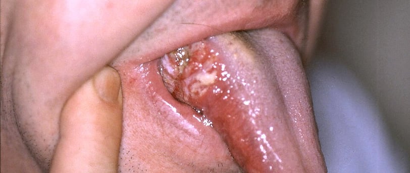 Early symptom of oral cancer in Indian women - mouth sore on tongue"