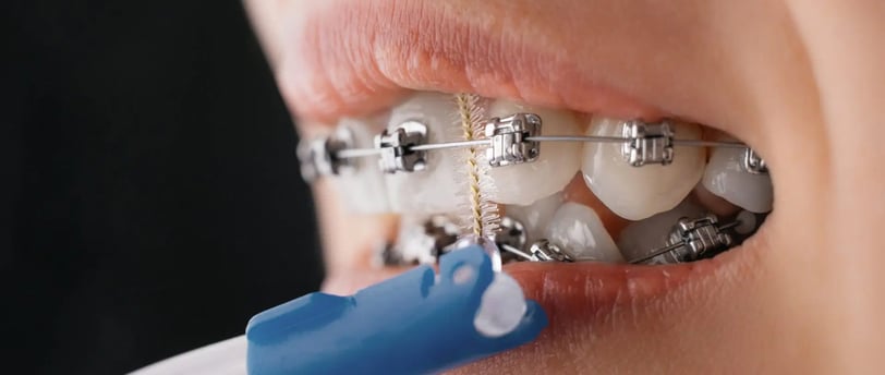 a mouth with metal braces on teeth brushed with orthodontic brushes in blue colour