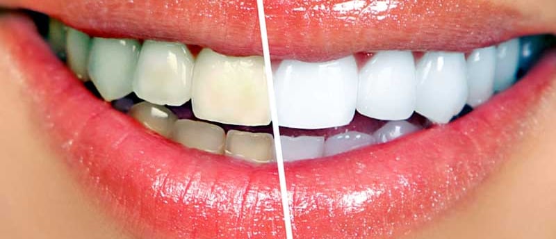 a image showing yellow teeth on one side and white teeth on other side