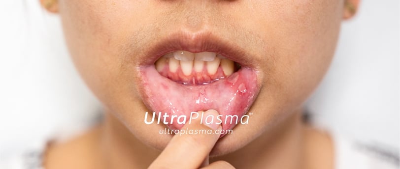 ultraplasma.com_aphthous-ulcer-or-canker-sore_treatment_ultra_plasma_ultra_plazma_ultra_plasma_ultra