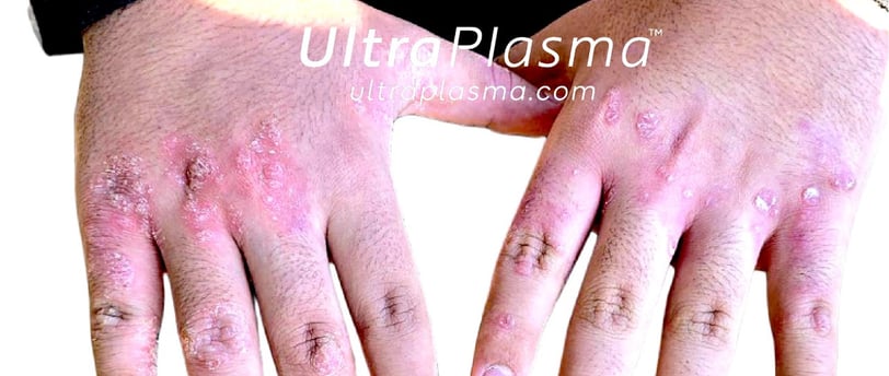 ultraplasma.com ultra plasma ultra plazma psoriasis sedef treatment tedavi