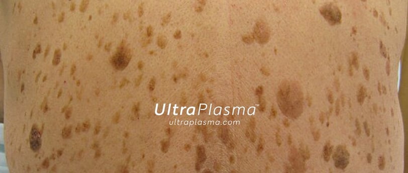 ultraplasma.com_seborrheik_keratosis_treatment_seboreik_keratoz_tedavisi_ultra_plasma_ultra_plazma