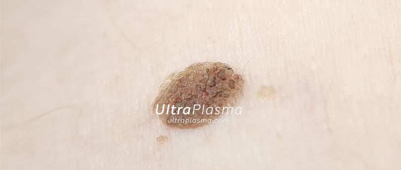 ultraplasma.com_seborrheik_keratosis_treatment_seboreik_keratoz_tedavisi_ultra_plasma_ultra_plazma