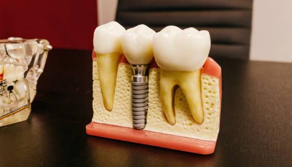 Dental Implants Treatment in Pune