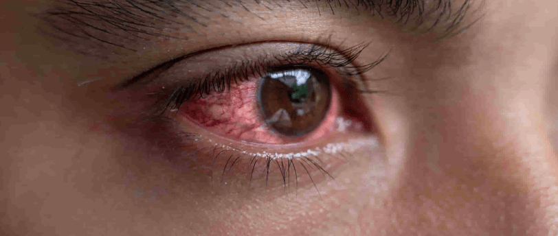 Eye Flu