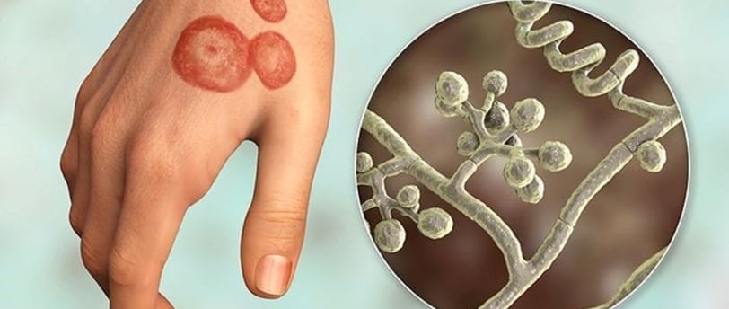 Ringworm Infections