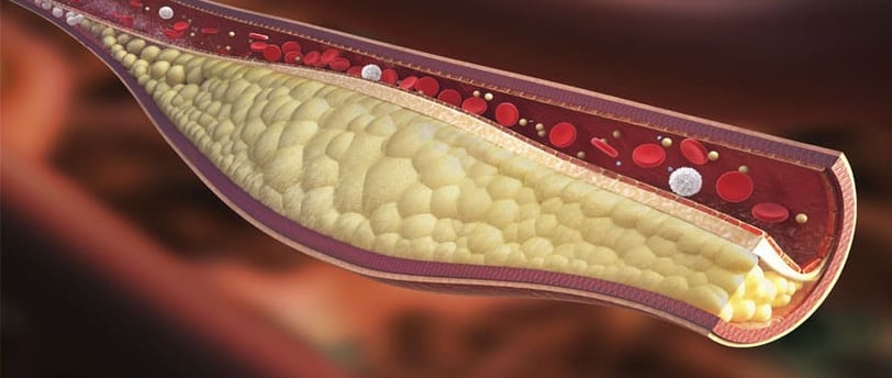 Kolesterol Testi Nedir? HDL, LDL ve Trigliserid Değerleri