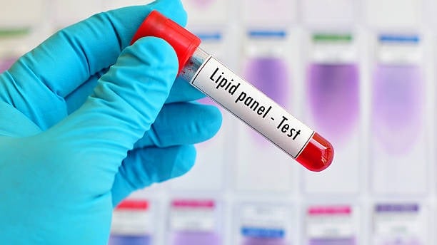Lipit Paneli Nedir? Kardiyovasküler Sağlık İçin Testler