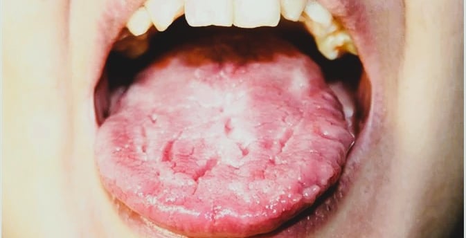 Candidiasis