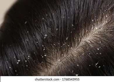 dandruff