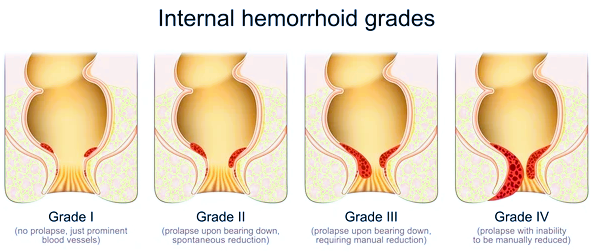 Hemorrhoids