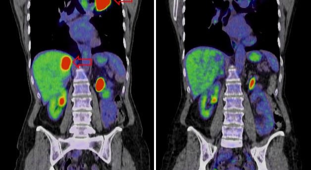 Liver Cancer