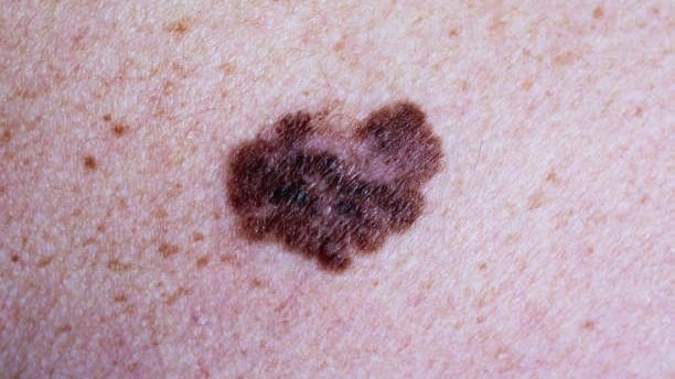 Melanoma
