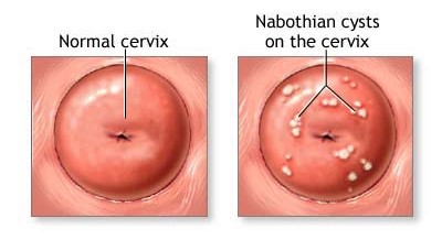 nabothian cysts
