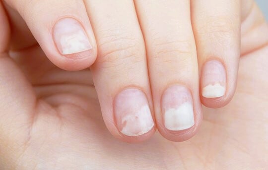 onycholysis