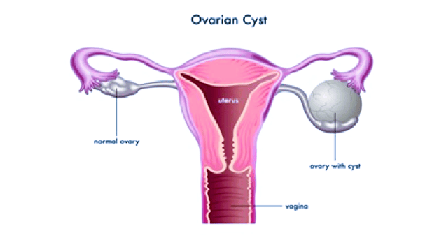 ovarian cysts