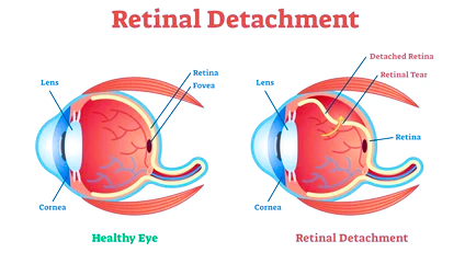 retina