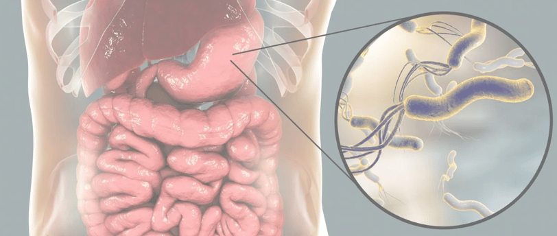 Small Intestinal Bacterial Overgrowth SIBO