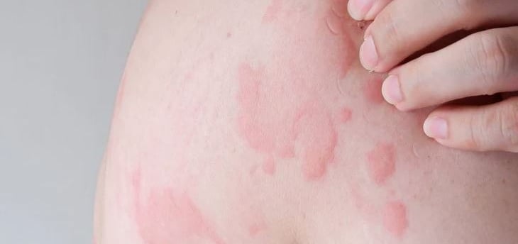 urticaria