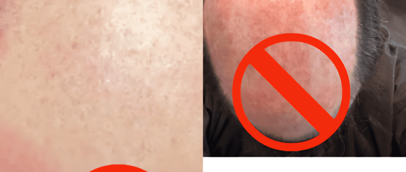 Use weetape hair wig tape to avoid skin iirritation