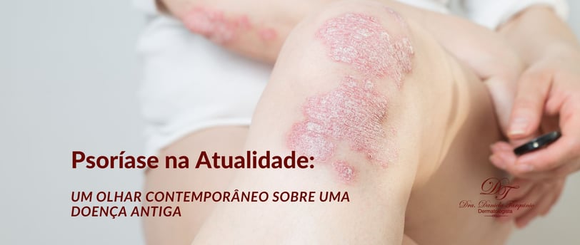 Psoríase Na Atualidade