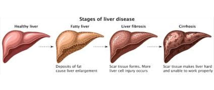 _Beware of the inevitable fate of fatty liver,fibrosis , cirrhosis, esophageal varices and hepatoma
