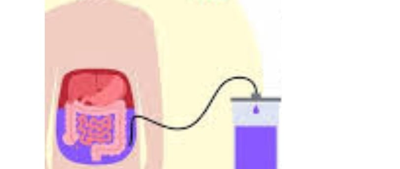 Abdominal Paracentesis Diagnostic and Therapeutic complementary issues