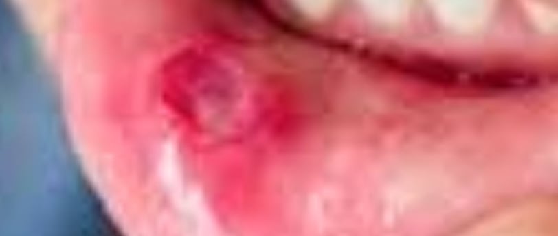 Behçet's Disease : A Comprehensive Overview and Treatments